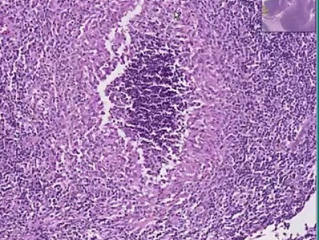 Tularemia