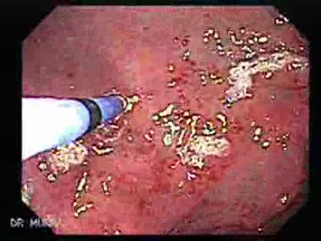 Gastric Antral Vascular Ectasias - GAVE (3 of 6)