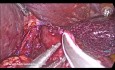 Heller Myotomy and Dor Fundoplication for Achalasia in an Obese Patient