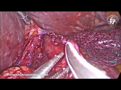 Heller Myotomy and Dor Fundoplication for Achalasia in an Obese Patient