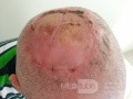 Angiosarcoma of the Scalp-Excision and Free Skin Flap Harvested From Both Inner Arms