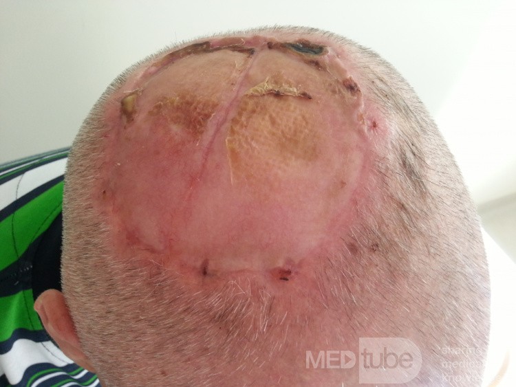 Angiosarcoma of the Scalp-Excision and Free Skin Flap Harvested From Both Inner Arms