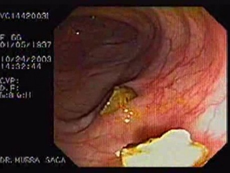 Diverticula With Fecalith (2 of 2)