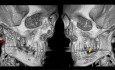 TMJ Function After Osteosynthesis of a Mandibular Condylar Fracture