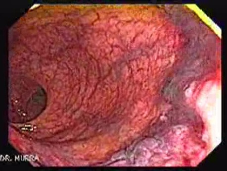 Internal Hemorrhoids (1 of 5)