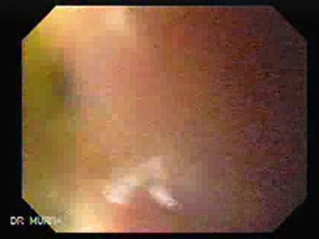 Alcoholic Cirrhosis - Rebleeding form Esophageal Varices