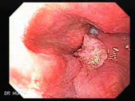Squamous cell carcinoma of the larynx 73-year-old smoker (1 of 4)