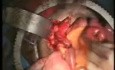 Psoas Hitch and Boari Flap for Complete Replacement of Ureter