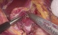 Laparoscopic Median Arcuate Ligament Release for MALS (Dunbar) Syndrome