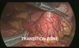 Laparoscopic Assisted Management of Small Intestinal Obstruction due to Foreign Body