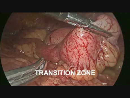 Laparoscopic Assisted Management of Small Intestinal Obstruction due to Foreign Body