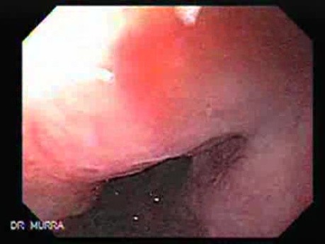 Gastroesophagic Varices - 66 - Year - Old Man (5 of 7) 