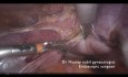 Hysterectomy on very huge uterus (More than 1000 grammes)