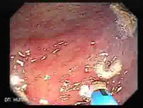 Colon Angiodysplasia (5 of 24)