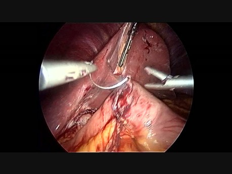 Two Step Biliopancreatic Diversion with Handsewn Duodenal Switch