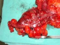 Severe case of Ischemic Colitis (14 of 19)