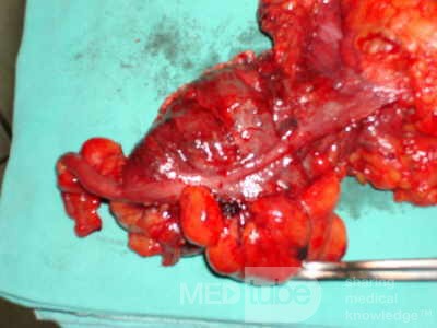 Severe case of Ischemic Colitis (14 of 19)