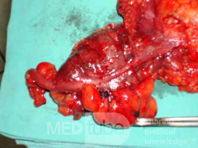Severe case of Ischemic Colitis (14 of 19)