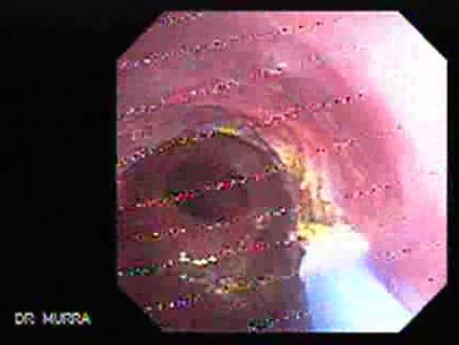 Barrett's Esophagus of long segment - Argon Plasma Coagulation (20 of 24)