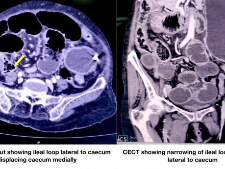 Laparoscopic Repair of Retrocaecal Hernia Causing Acute Small Bowel Obstruction