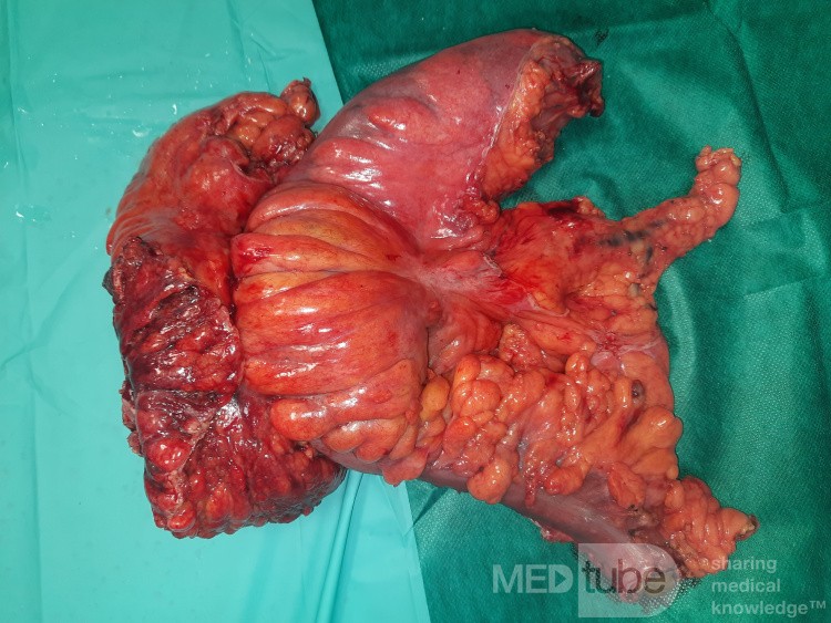 Multivisceral Resection Specimen