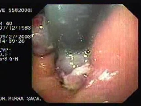 Acute Variceal Bleeding - Retroflexed View of Gastric Cardias 