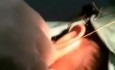 Auriculoplasty 