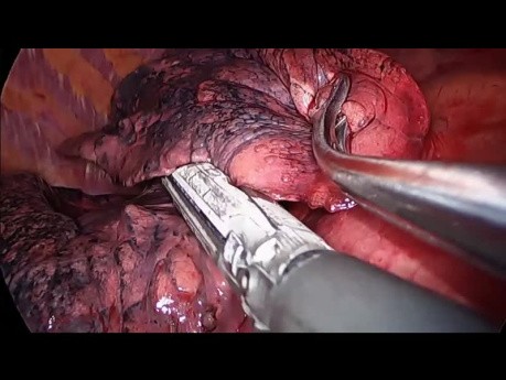 Subxiphoid Uniportal VATS Bilateral Surgery