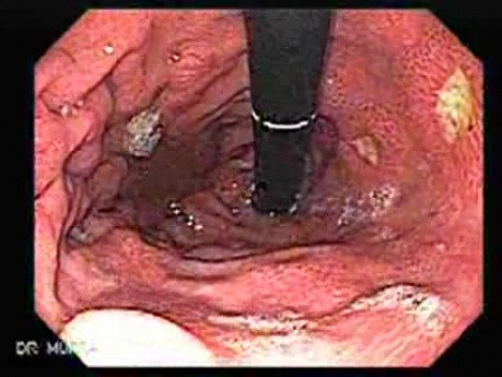 Multiple Gastric Ulcers - Endoscopy (1 of 10)