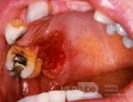 Erythroplakia [carcinoma in situ]