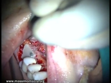 Regeneration Of Multialveolar Process 16-17 (1/4