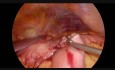 Intracorporeal Laparoscopic Handmade Gastro-Enteroanastomosis and Brown Anastomosis in Advanced Distal Gastric Cancer