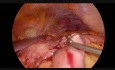 Intracorporeal Laparoscopic Handmade Gastro-Enteroanastomosis and Brown Anastomosis in Advanced Distal Gastric Cancer
