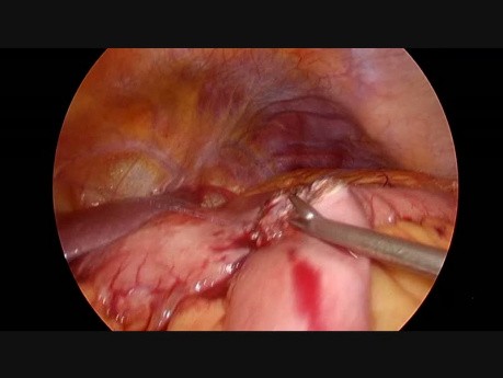 Intracorporeal Laparoscopic Handmade Gastro-Enteroanastomosis and Brown Anastomosis in Advanced Distal Gastric Cancer