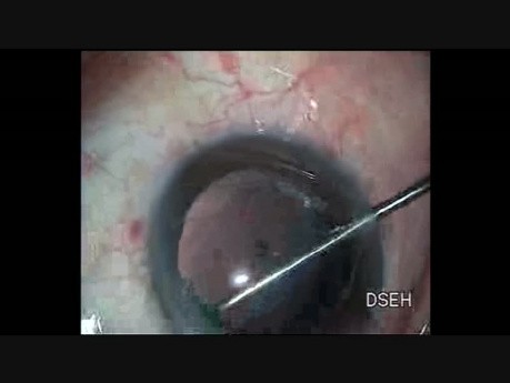 Hydrodissection by Mistake in a Case of PPC 