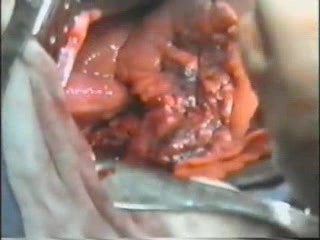 Lobectomy With Lymphadenectomy