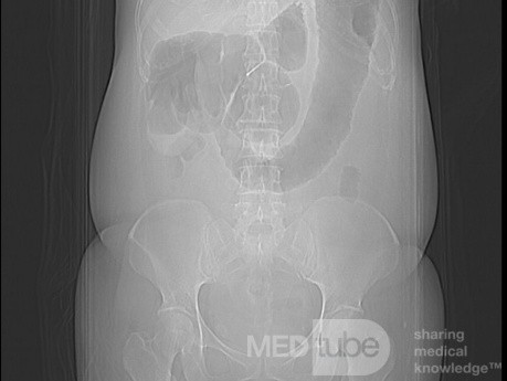 Multiple Rectal Ulcers (32 of 110)
