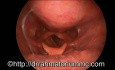 Laryngeal Inlet Obstruction caused by Retropharyngeal Malignant Tumour