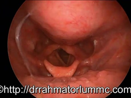 Laryngeal Inlet Obstruction caused by Retropharyngeal Malignant Tumour