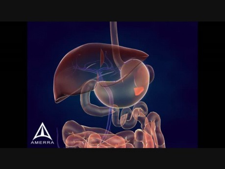 Whipple Procedure - 3D Medical Animation