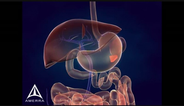 Whipple Procedure - 3D Medical Animation • Video • 