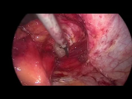 Laparoscopic Parastomal Hernia Repair by Modified Sugarbacker Technique