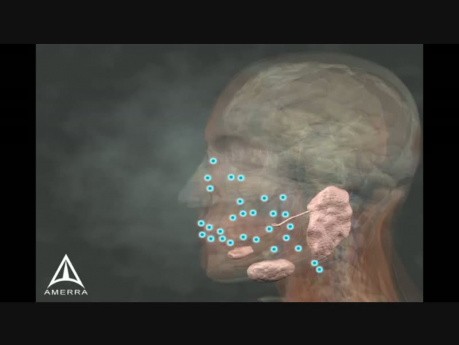 Sialorrhea Injection Site Identification - 3D Medical Animation