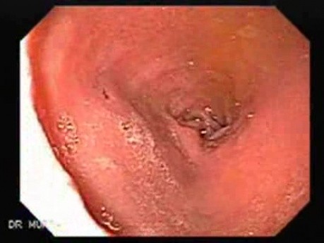 Duodenal Angiodysplasia (1 of 3)