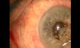 Surgical management of capsule contraction syndrome