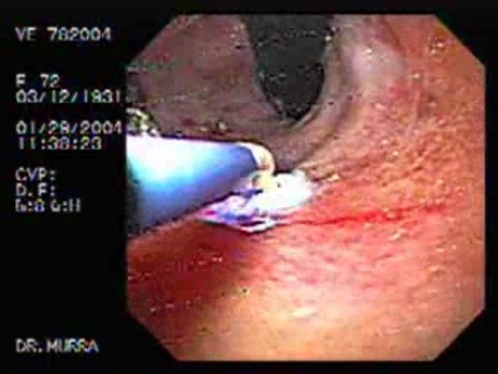 Mallory-Weiss Syndrome - Hemostatic Therapy with Argon Plasma Coagulator, Part 1