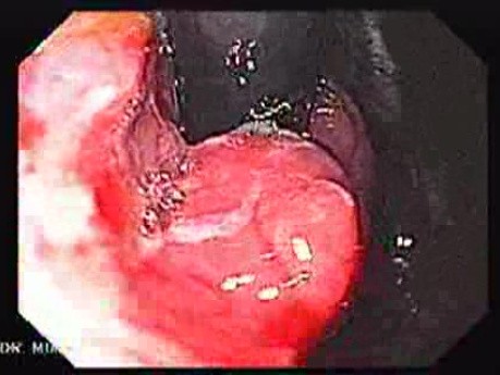 Adenocarcinoma of the Cardia (2 of 4)