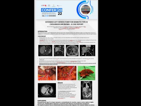 Case Presentation Extended Left Hepatectomy for Bismuth Type IV Cholangiocarcinoma