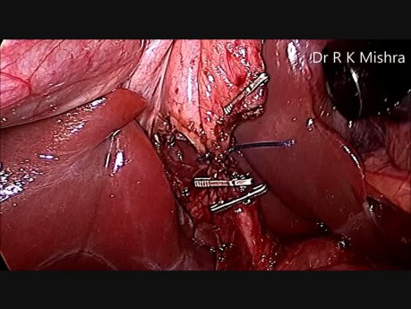 Laparoscopic Cholecystectomy and Appendectomy in Pediatric Patient