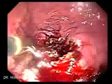 Debulking Of The Esophageal Tumor - Forceps - 1/2
